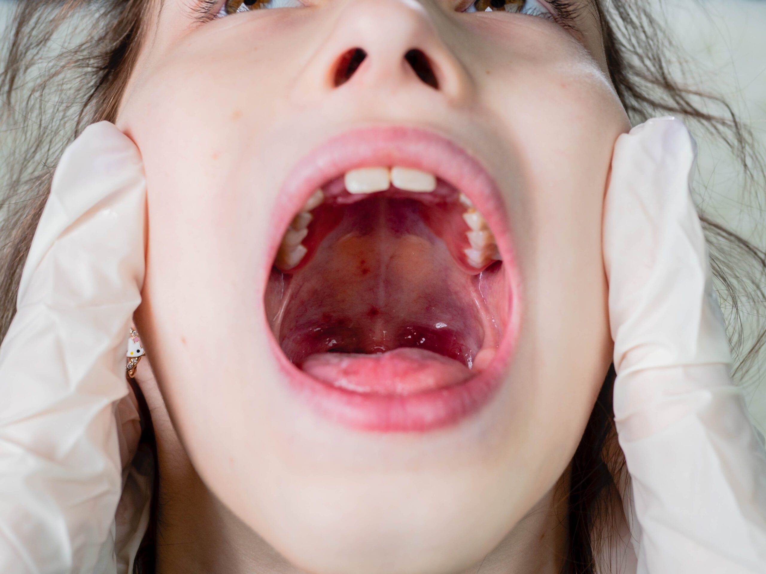 Pharyngitis